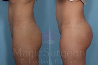 Palladino Patient Butt Implants