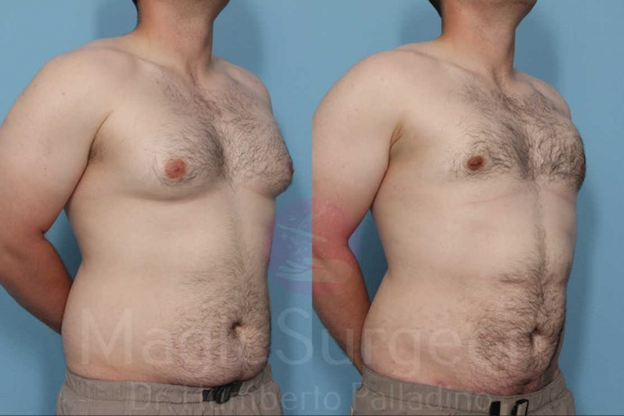How to Treat Gynecomastia