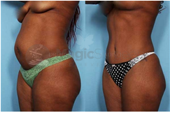 Tummy Tuck Before and After Photos