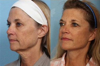 You Might Need a Neck Lift if…