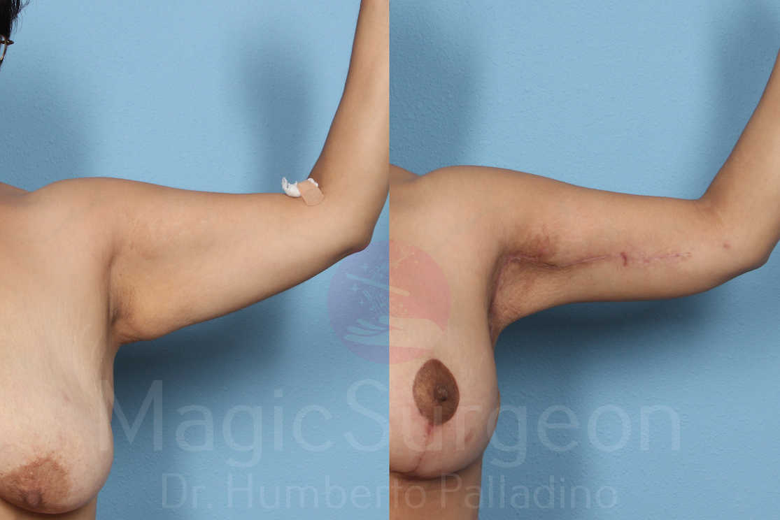 Arm Lift Patient 01, before and after