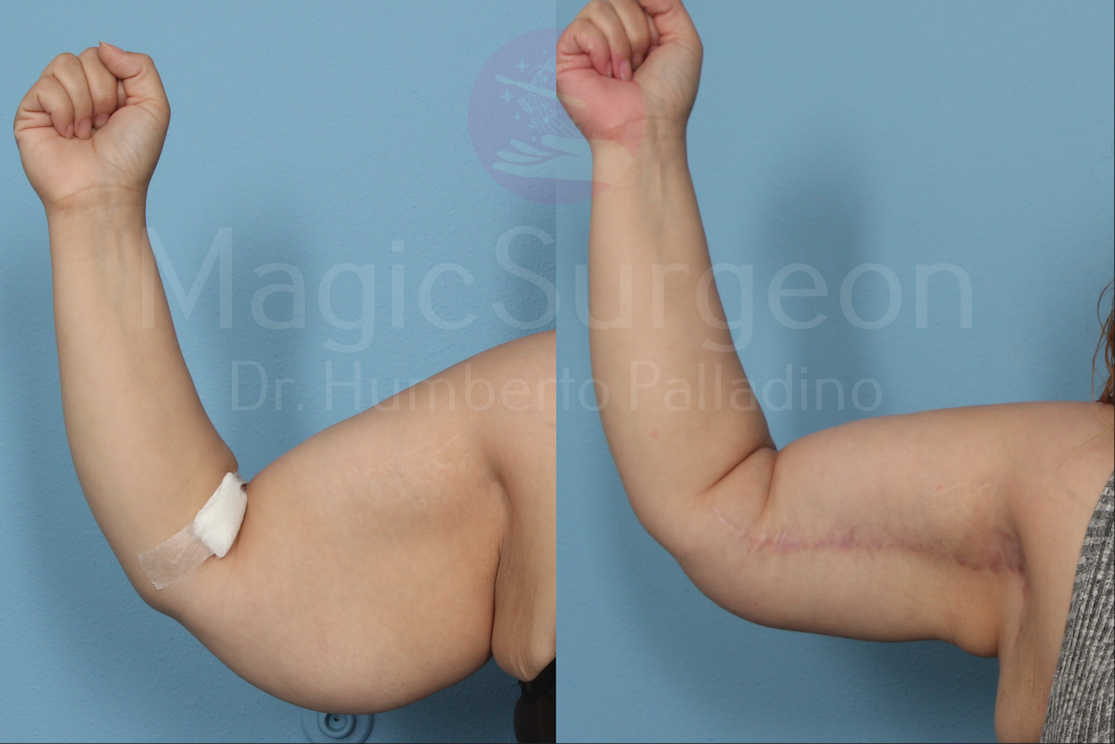 Arm Lift Patient 02, before and after