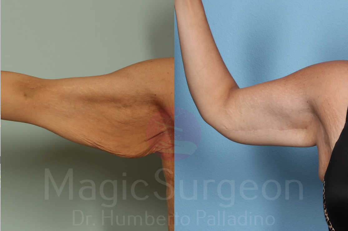 Arm Lift Patient 03, before and after