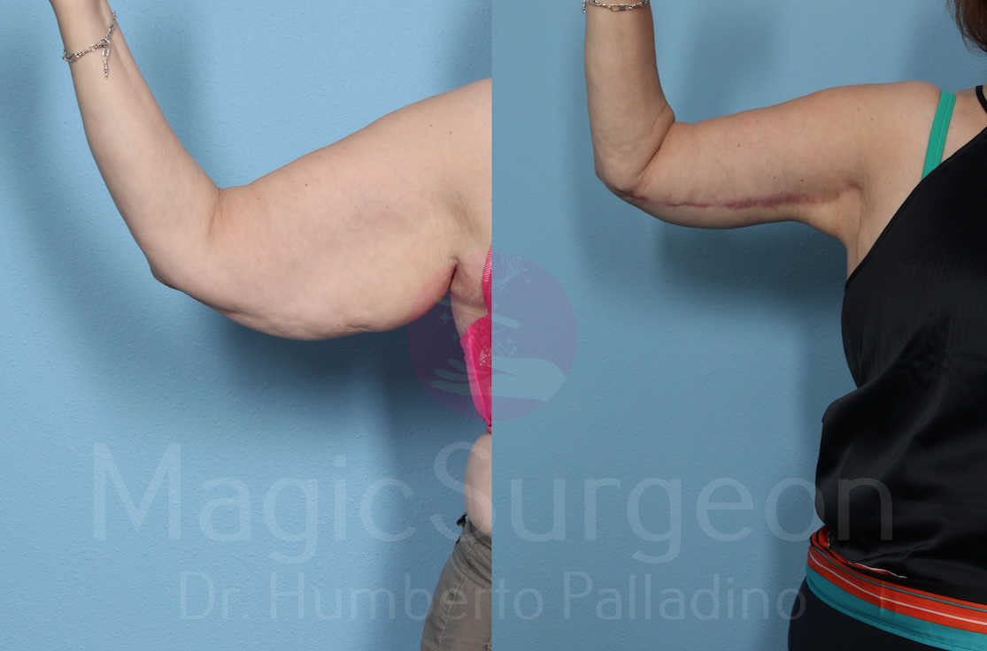 Arm Lift Patient 04, before and after