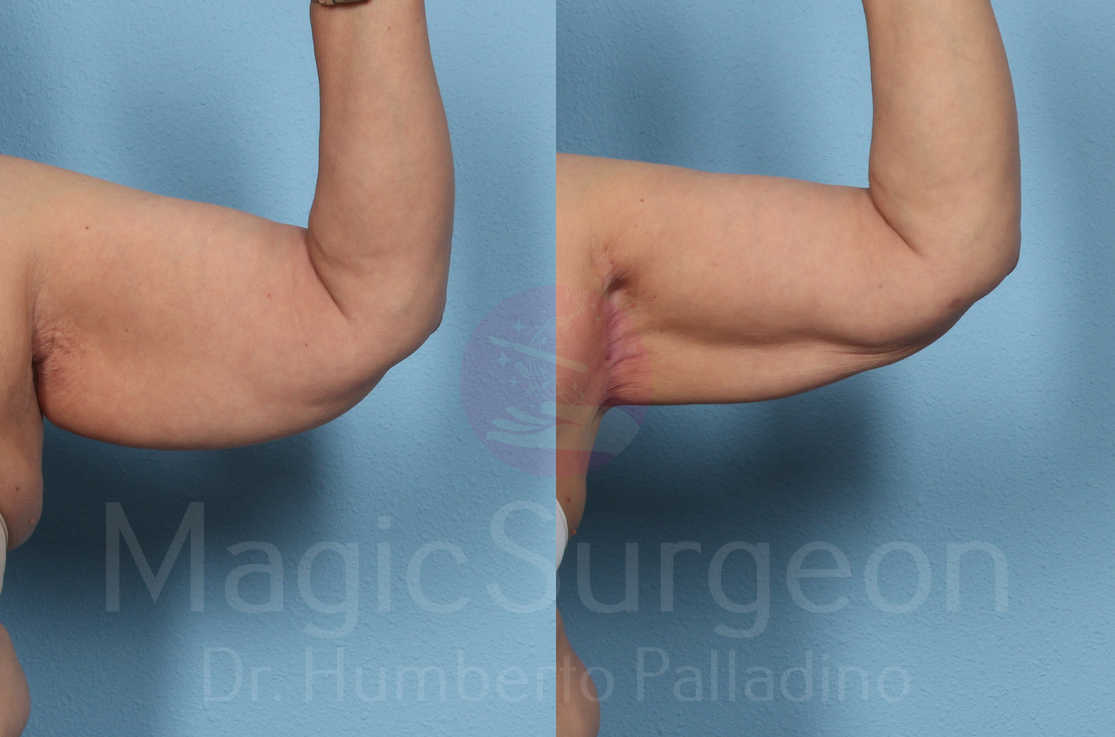 Arm Lift Patient 05, before and after