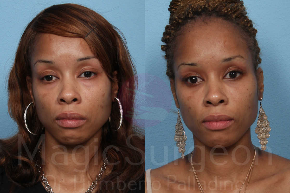 Blepharoplasty Patient 01, before and after