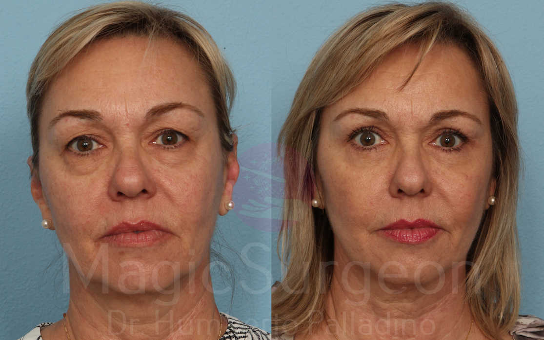 Blepharoplasty Patient 02, before and after