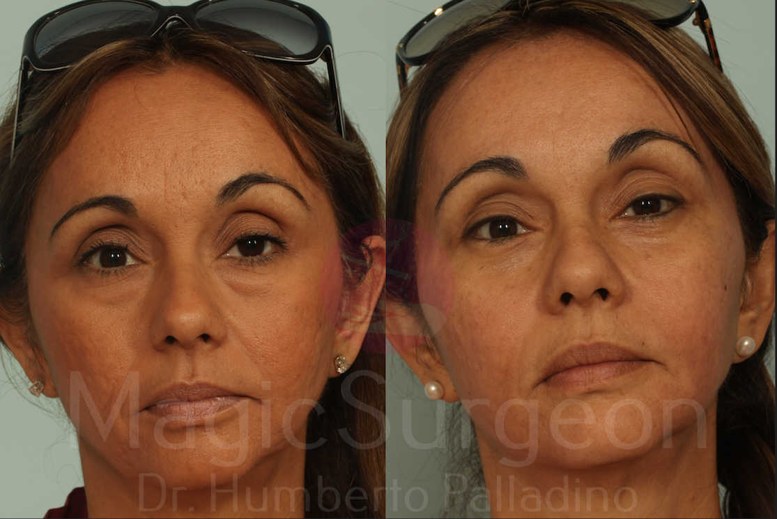 Blepharoplasty Patient 03, before and after