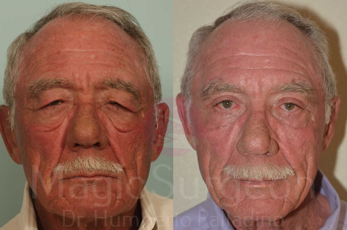 Blepharoplasty Patient 04, before and after