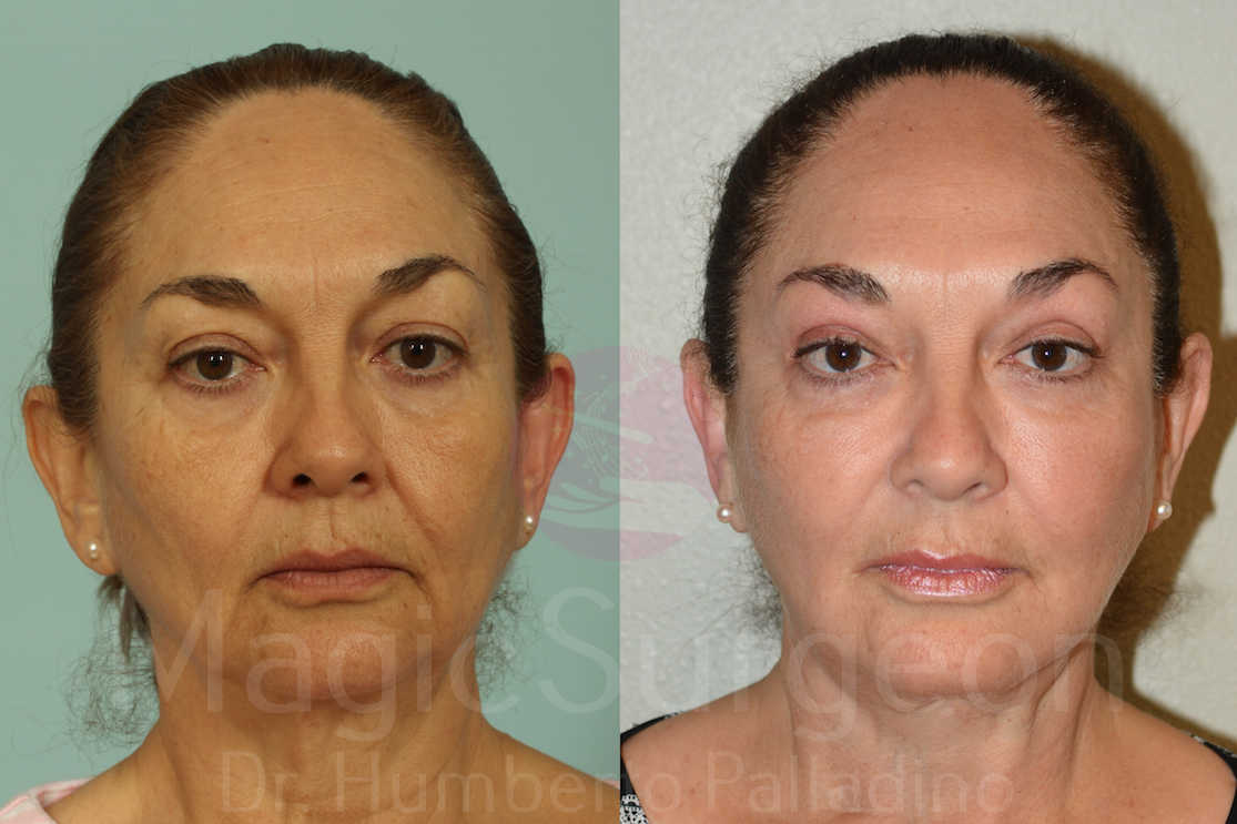 Blepharoplasty Patient 05, before and after
