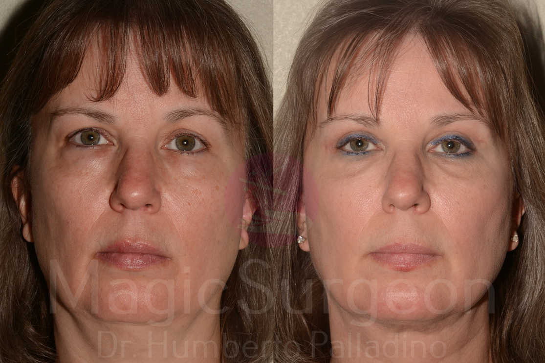 Blepharoplasty Patient 06, before and after