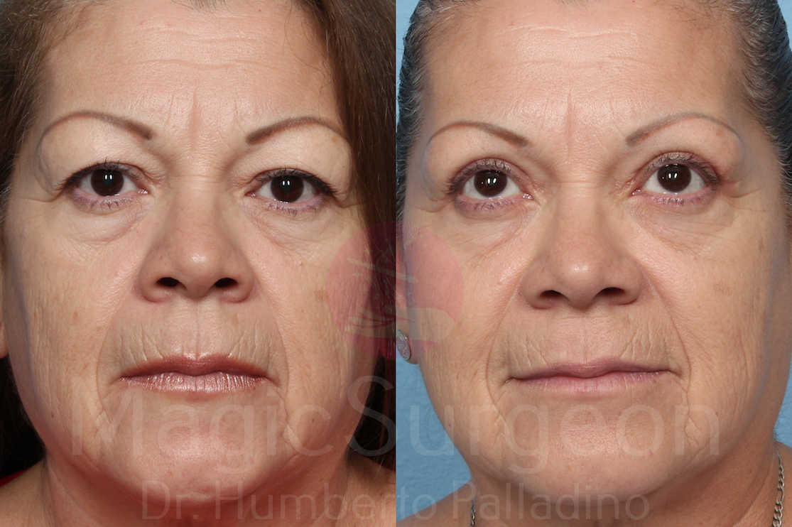 Blepharoplasty Patient 07, before and after
