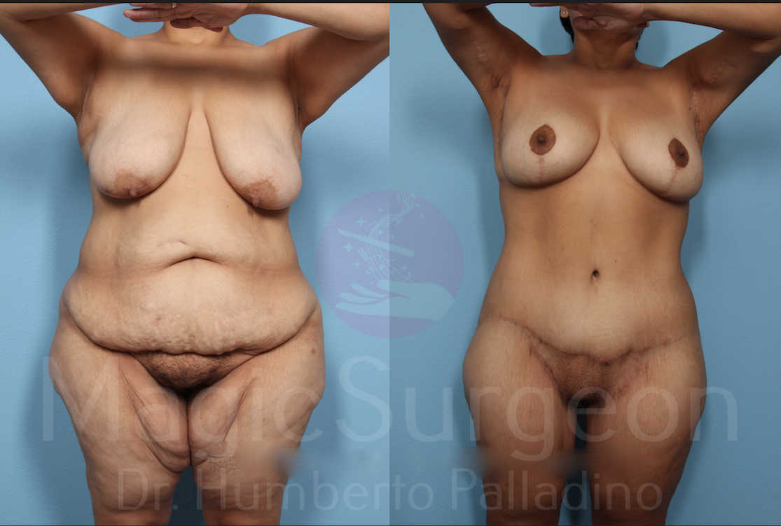 Body Contouring Patient 01, before and after