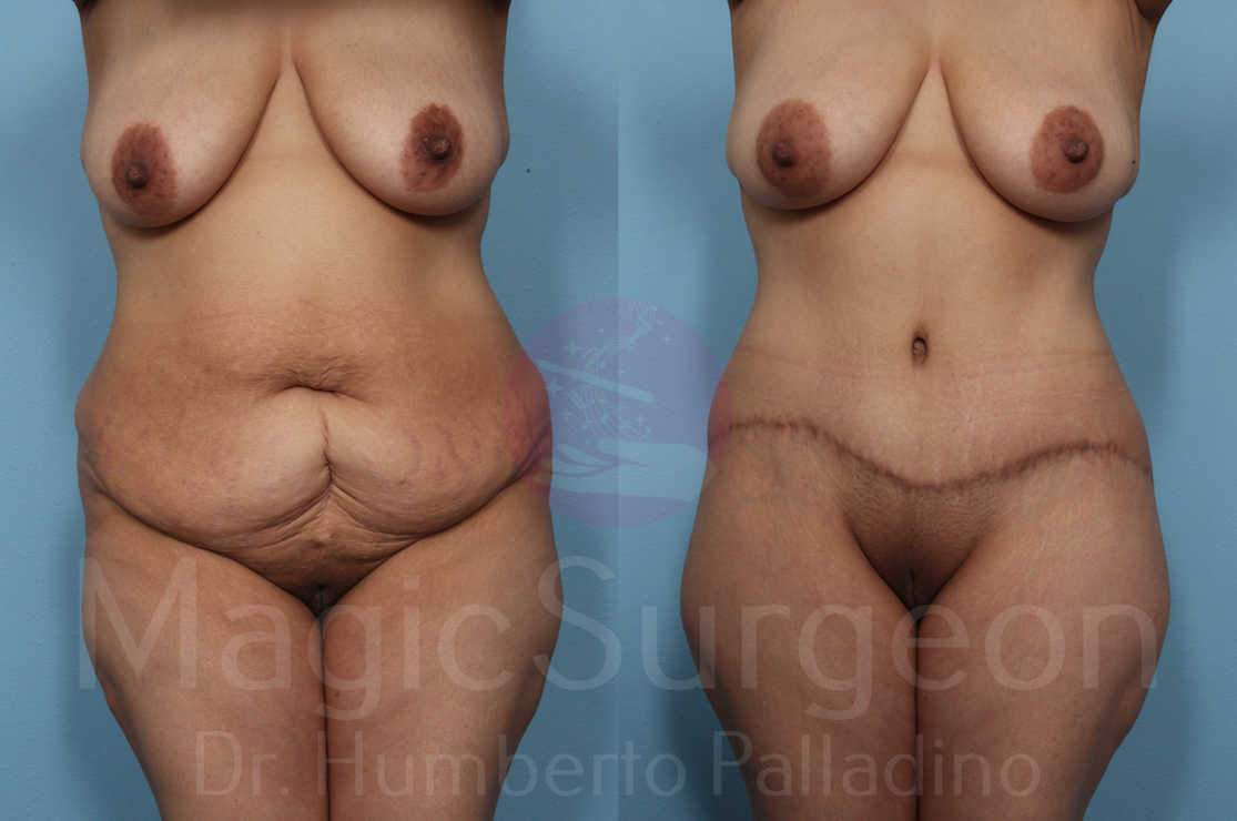 Body Contouring Patient 03, before and after