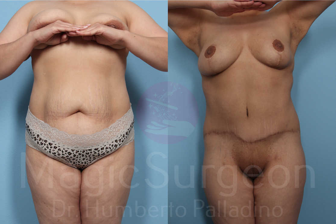 Body Contouring Patient 04, before and after