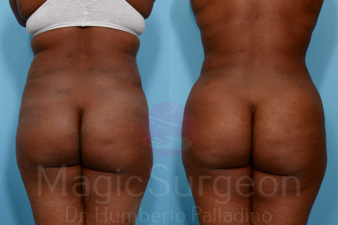 Brazilian Butt Lift Patient 01, before and after
