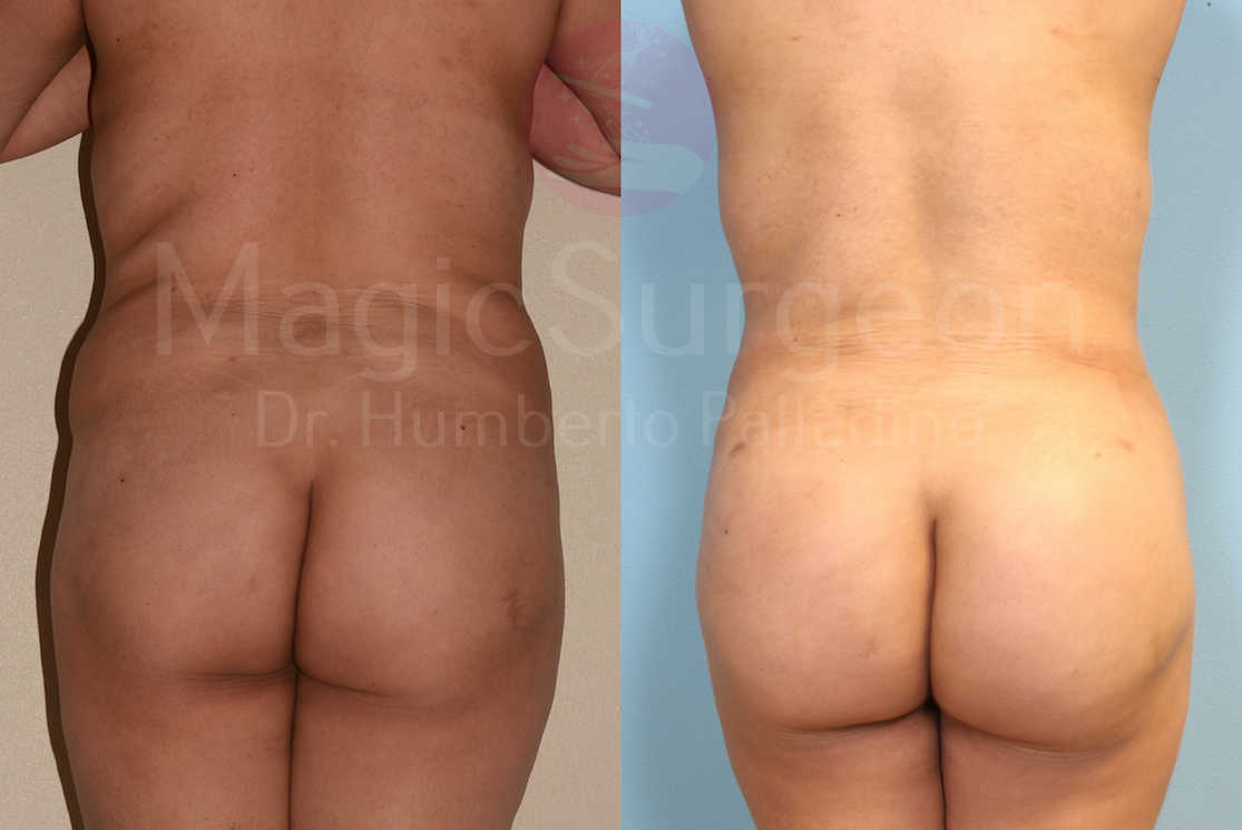 Brazilian Butt Lift Patient 02, before and after