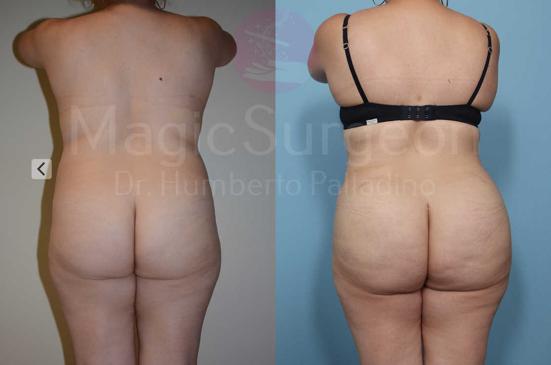Brazilian Butt Lift Patient 03, before and after