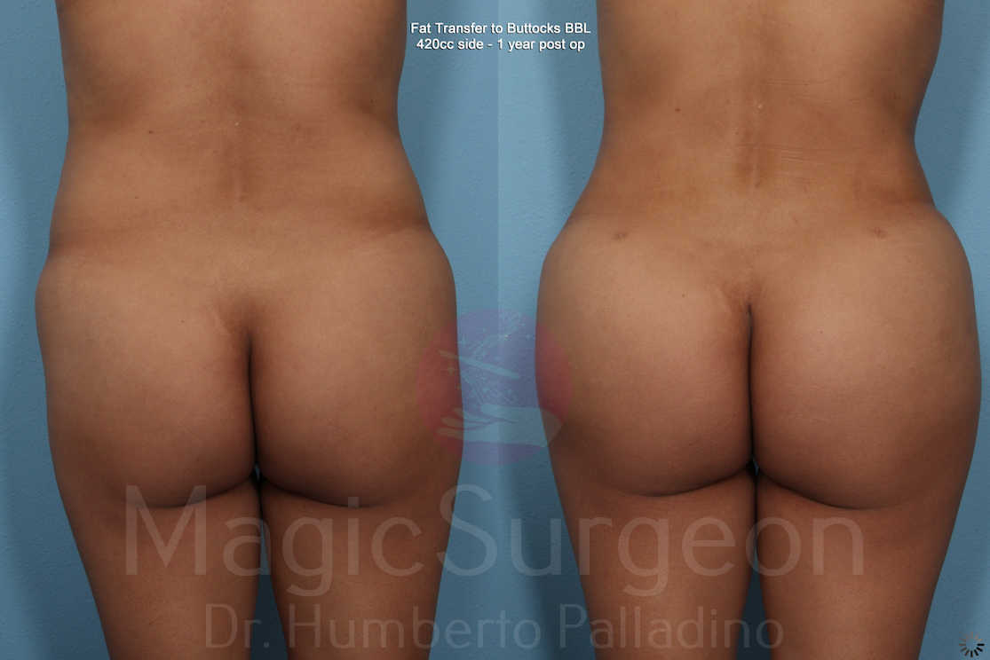 Brazilian Butt Lift Patient 04, before and after