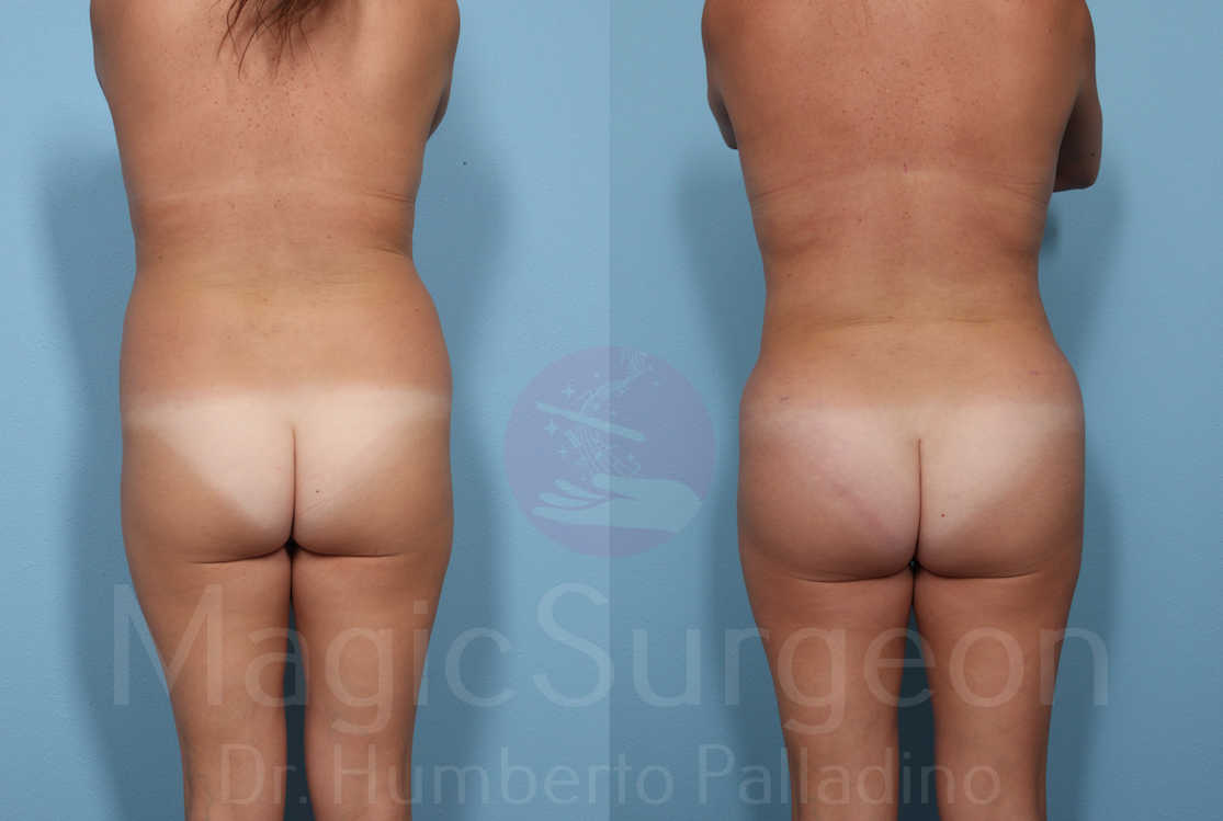 Brazilian Butt Lift Patient 05, before and after