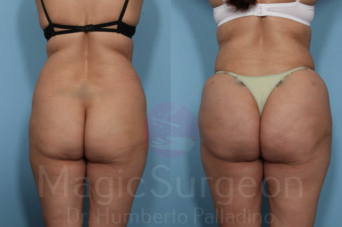 Brazilian Butt Lift Patient 06, before and after
