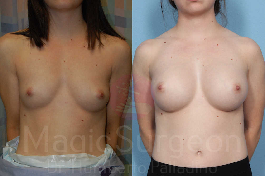 Breast Augmentation Patient 03, before and after