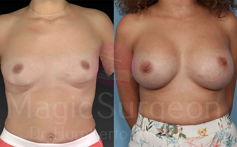Breast Augmentation Patient 02, before and after