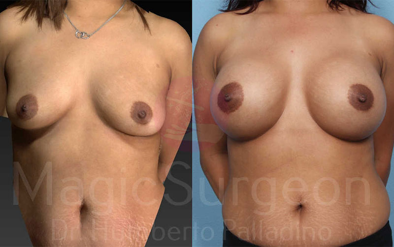Breast Augmentation Patient 04, before and after