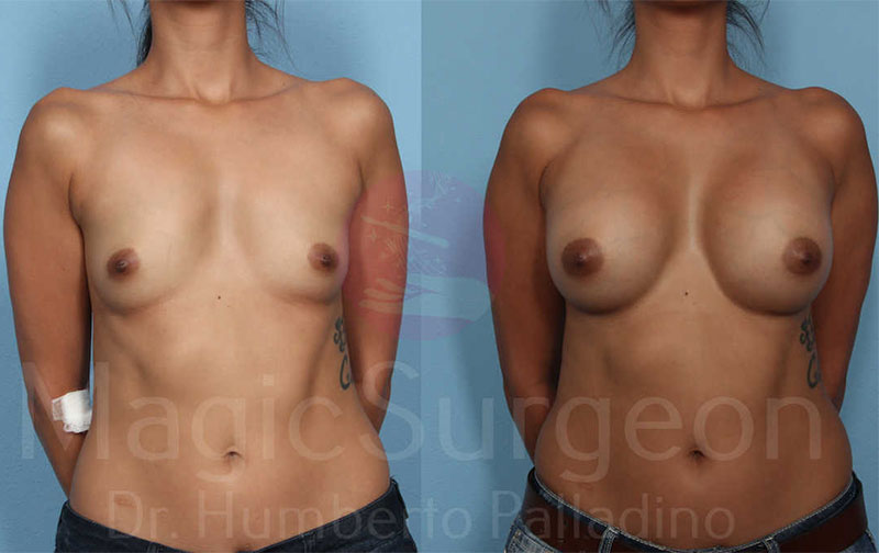 Breast Augmentation Patient 05, before and after