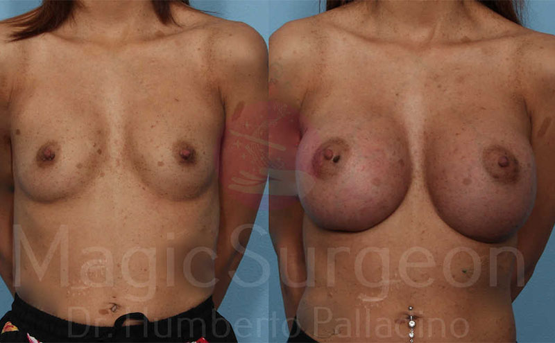 Breast Augmentation Patient 08, before and after