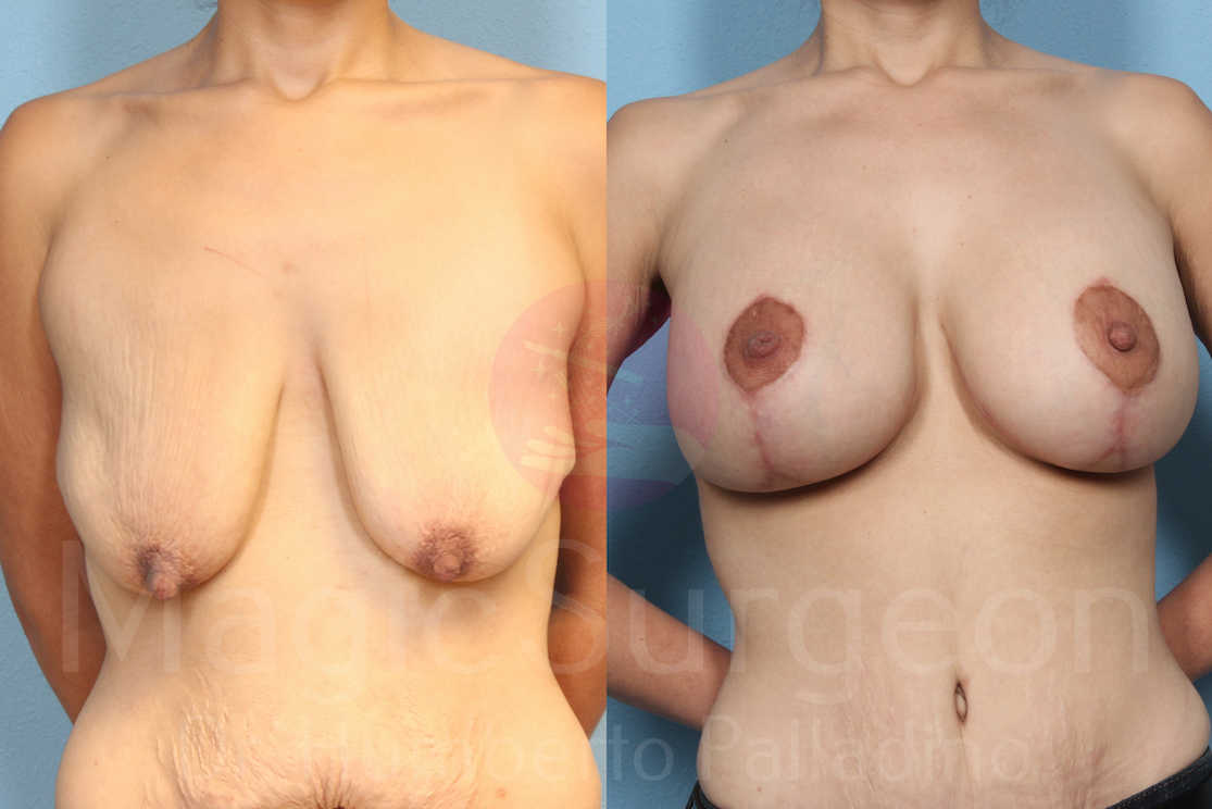 Breast Lift Patient 01, before and after
