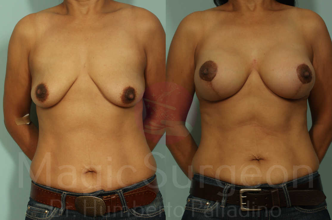 Breast Lift Patient 04, before and after