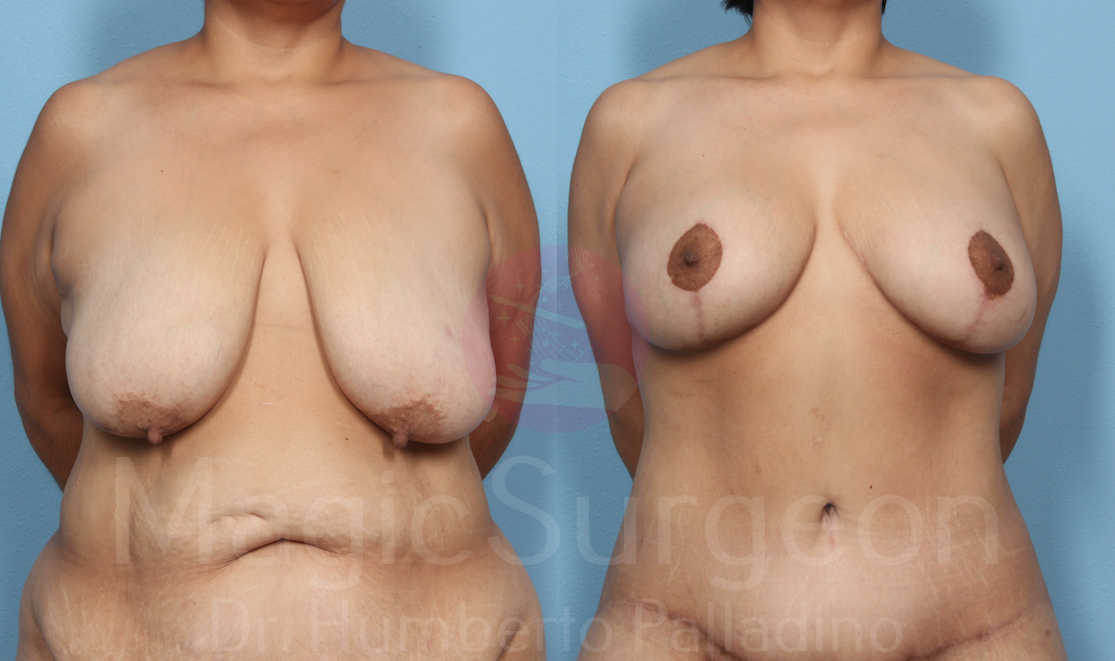 Breast Lift Patient 06, before and after