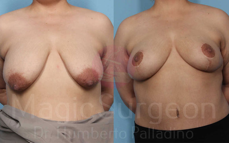 Breast Lift Patient 08, before and after