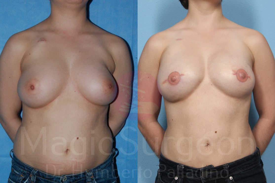 Breast Reconstruction Patient 01, before and after