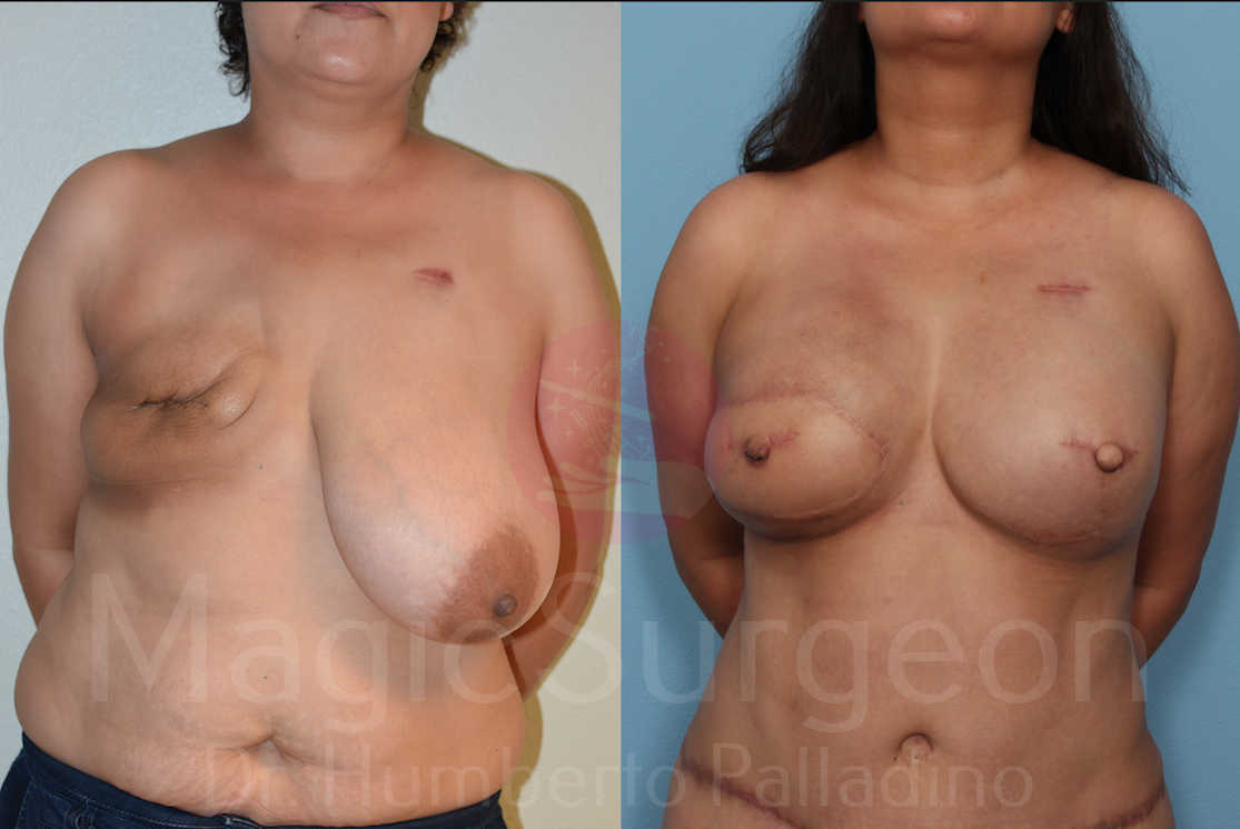 Breast Reconstruction Patient 02, before and after