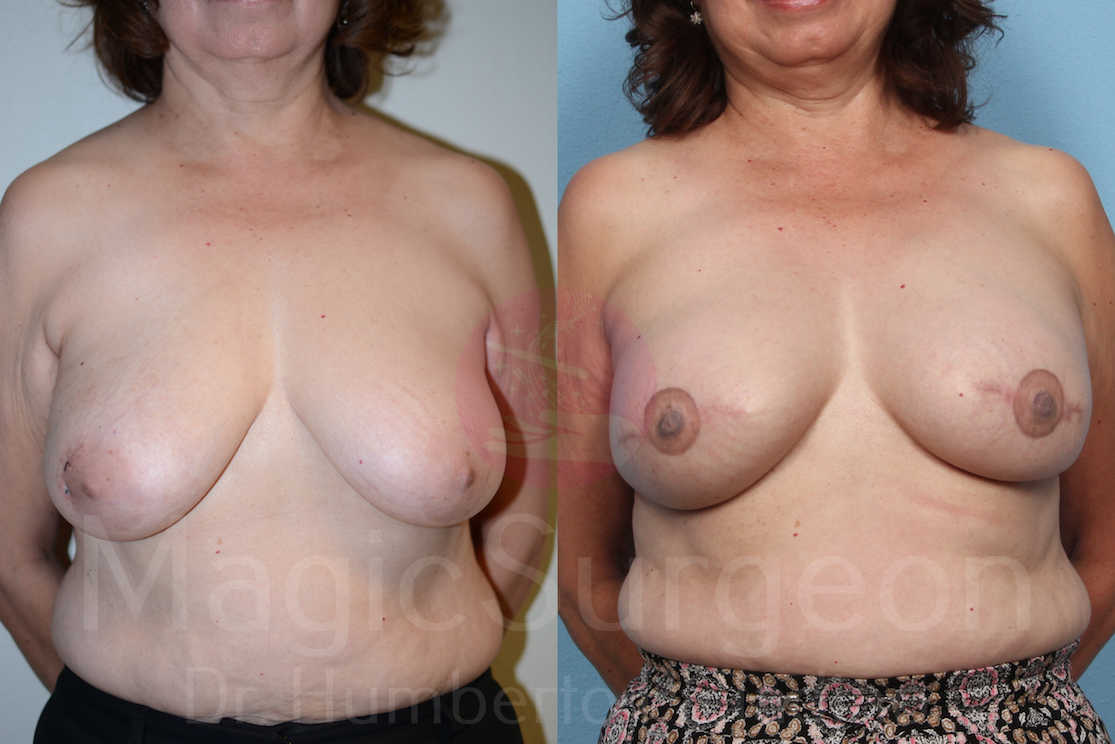 Breast Reconstruction Patient 03, before and after