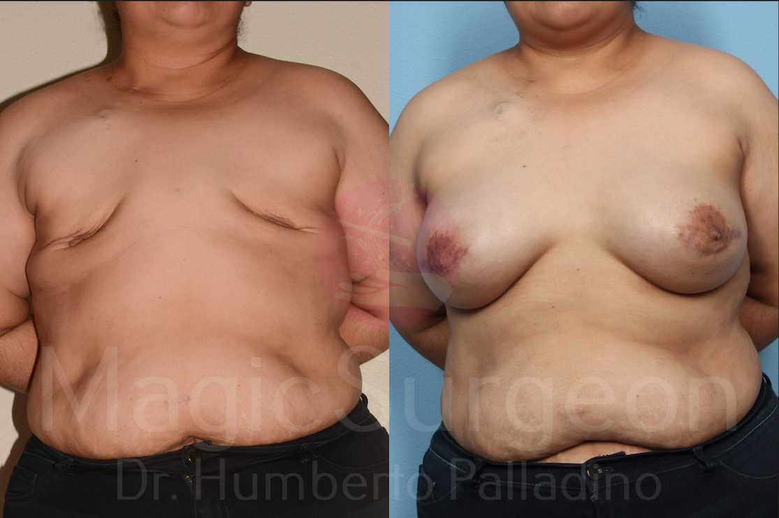 Breast Reconstruction Patient 05, before and after