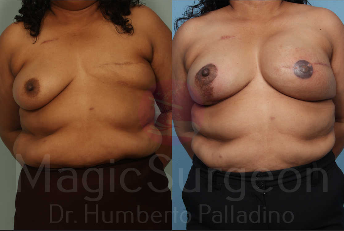 Breast Reconstruction Patient 06, before and after