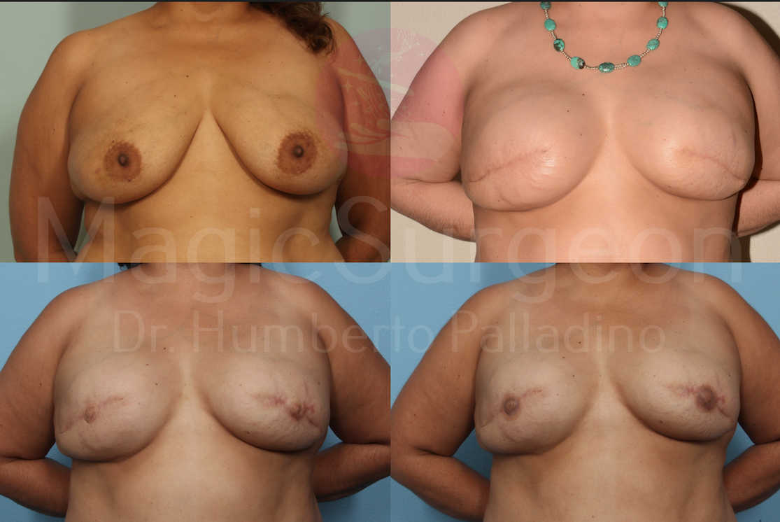 Breast Reconstruction Patient 07, before and after