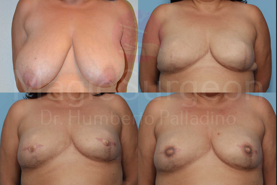 Breast Reconstruction Patient 08, before and after