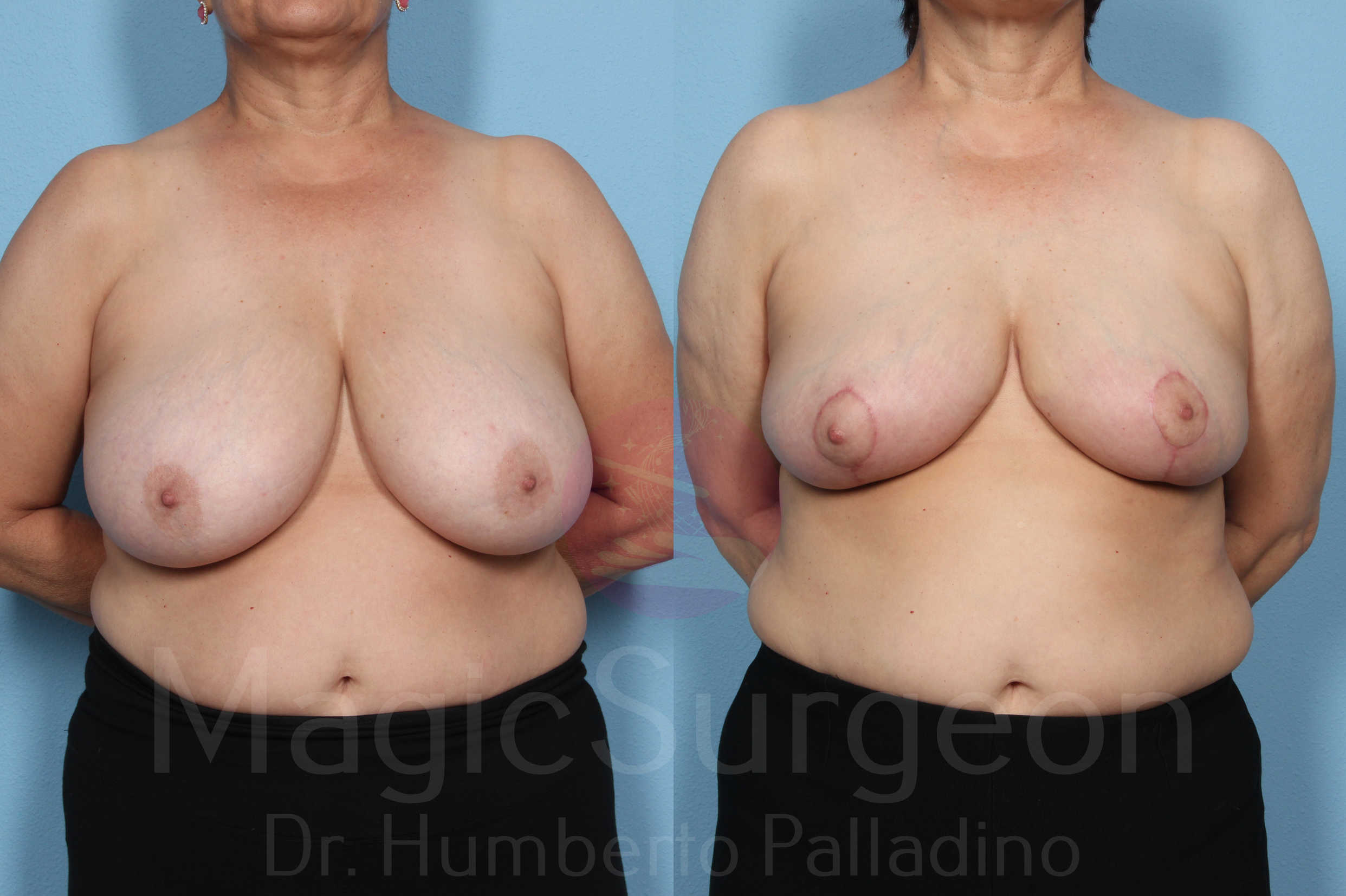 Breast Reduction Patient 02, before and after