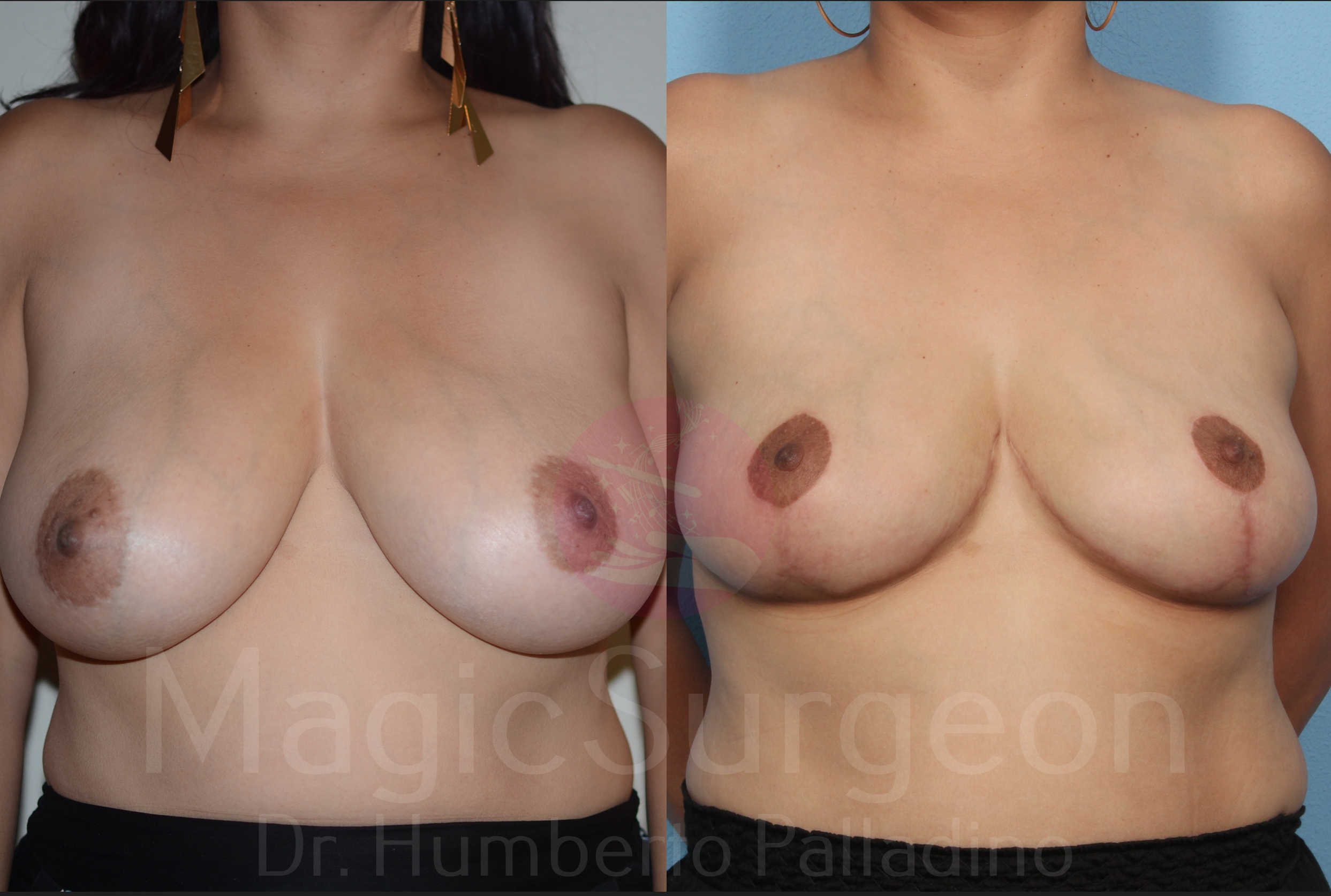 Breast Reduction Patient 03, before and after