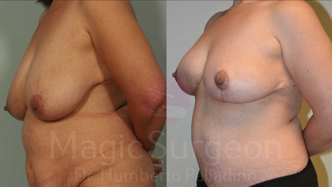Breast Reduction Patient 04, before and after