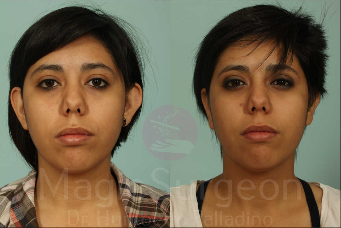 Buccal Fat Pad Removal Patient 01, before and after