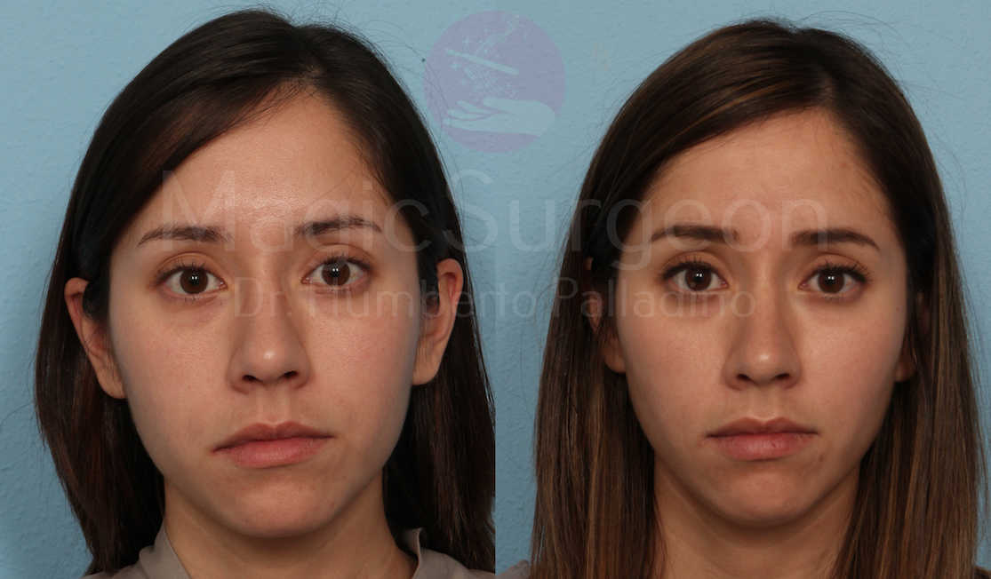 Buccal Fat Pad Removal Patient 02, before and after