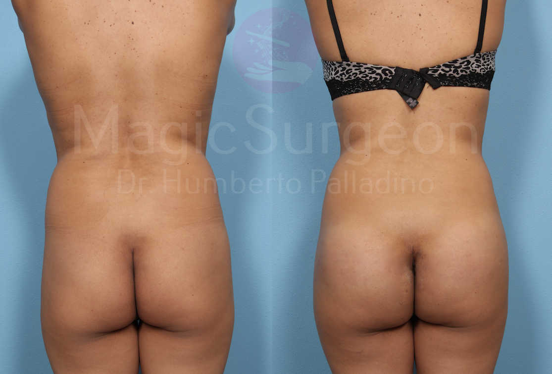 Butt Implant Patient 01, before and after