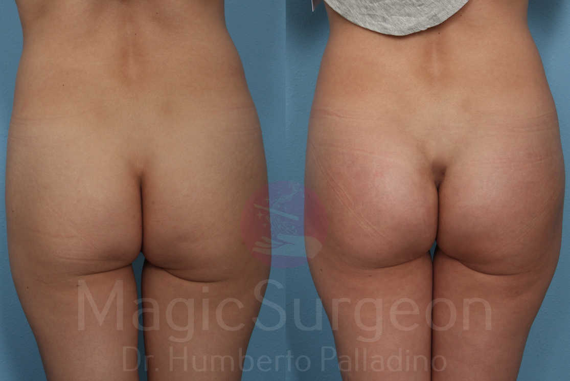 Butt Implant Patient 02, before and after