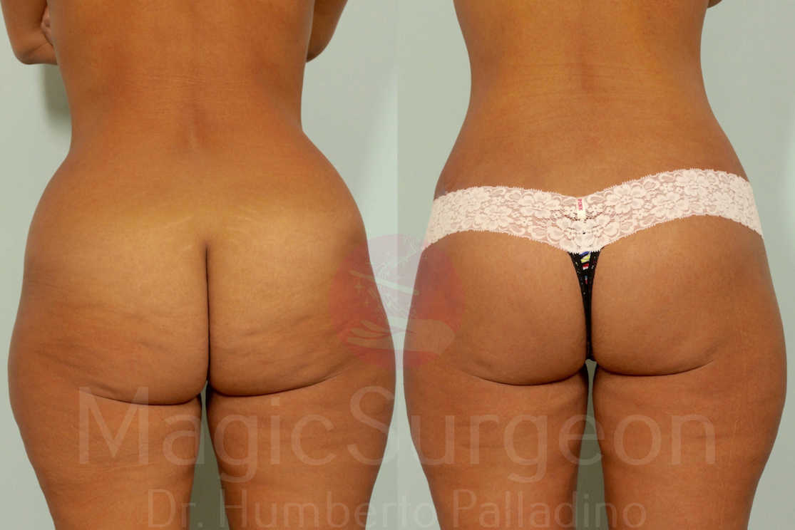 Buttock Lift Patient 01, before and after