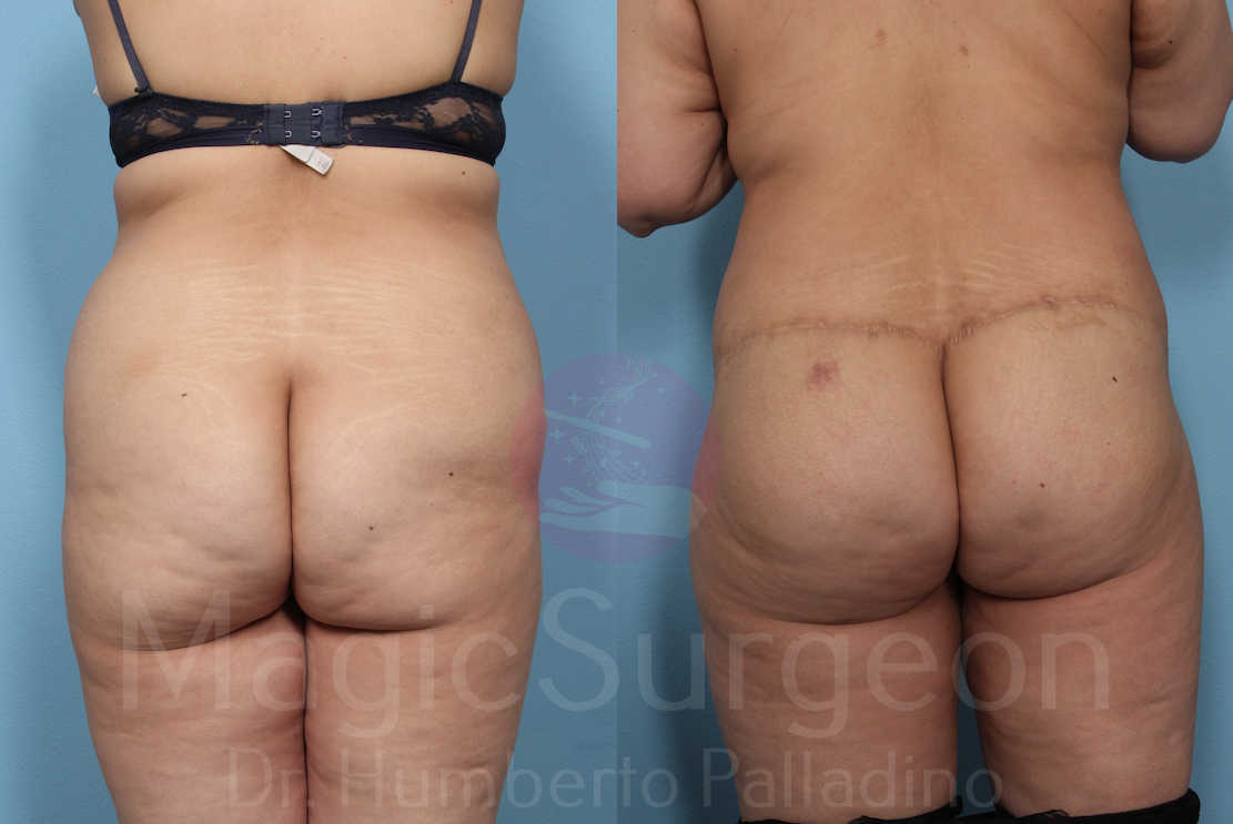 Buttock Lift Patient 03, before and after